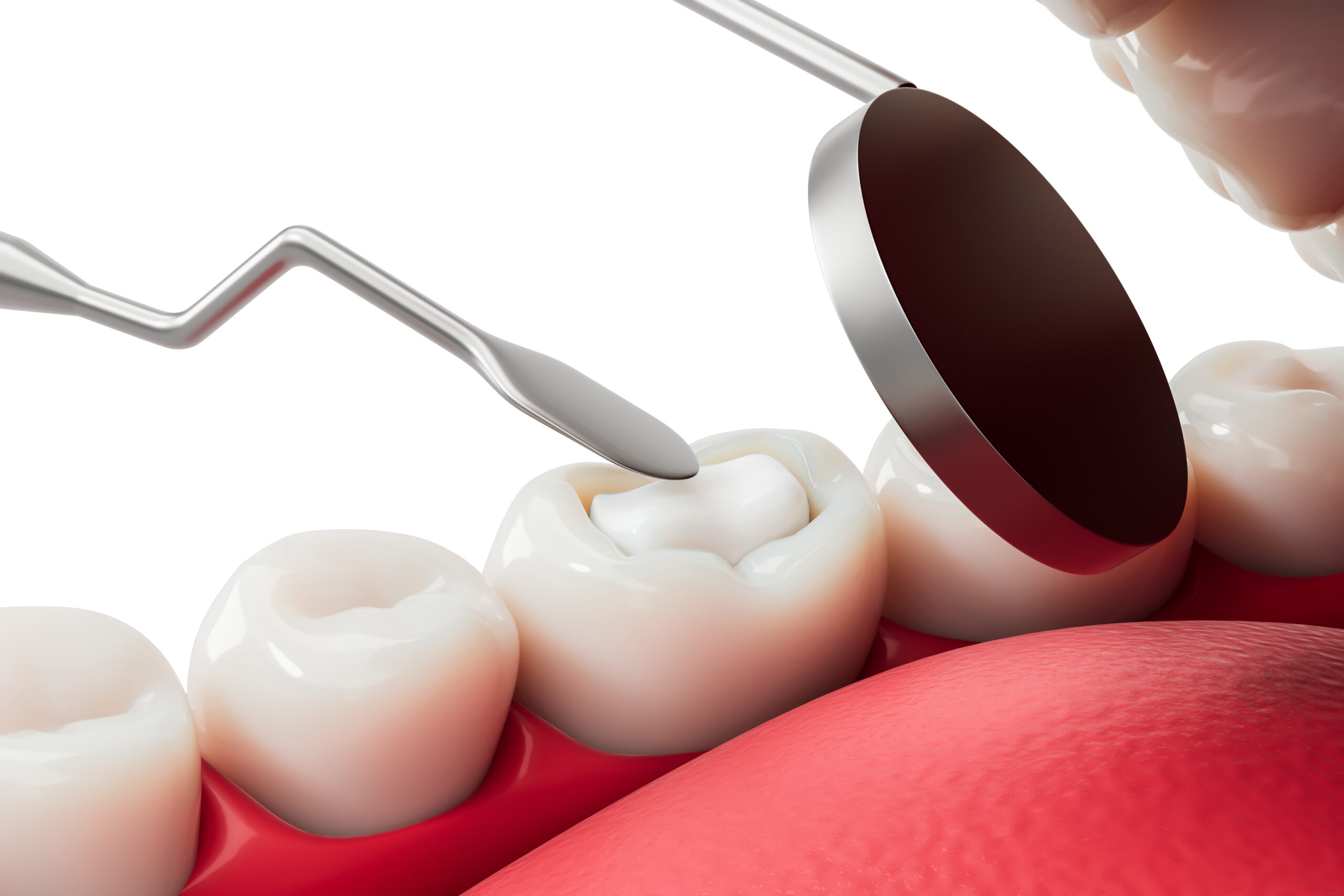 Who Can Benefit From Dental Sealants