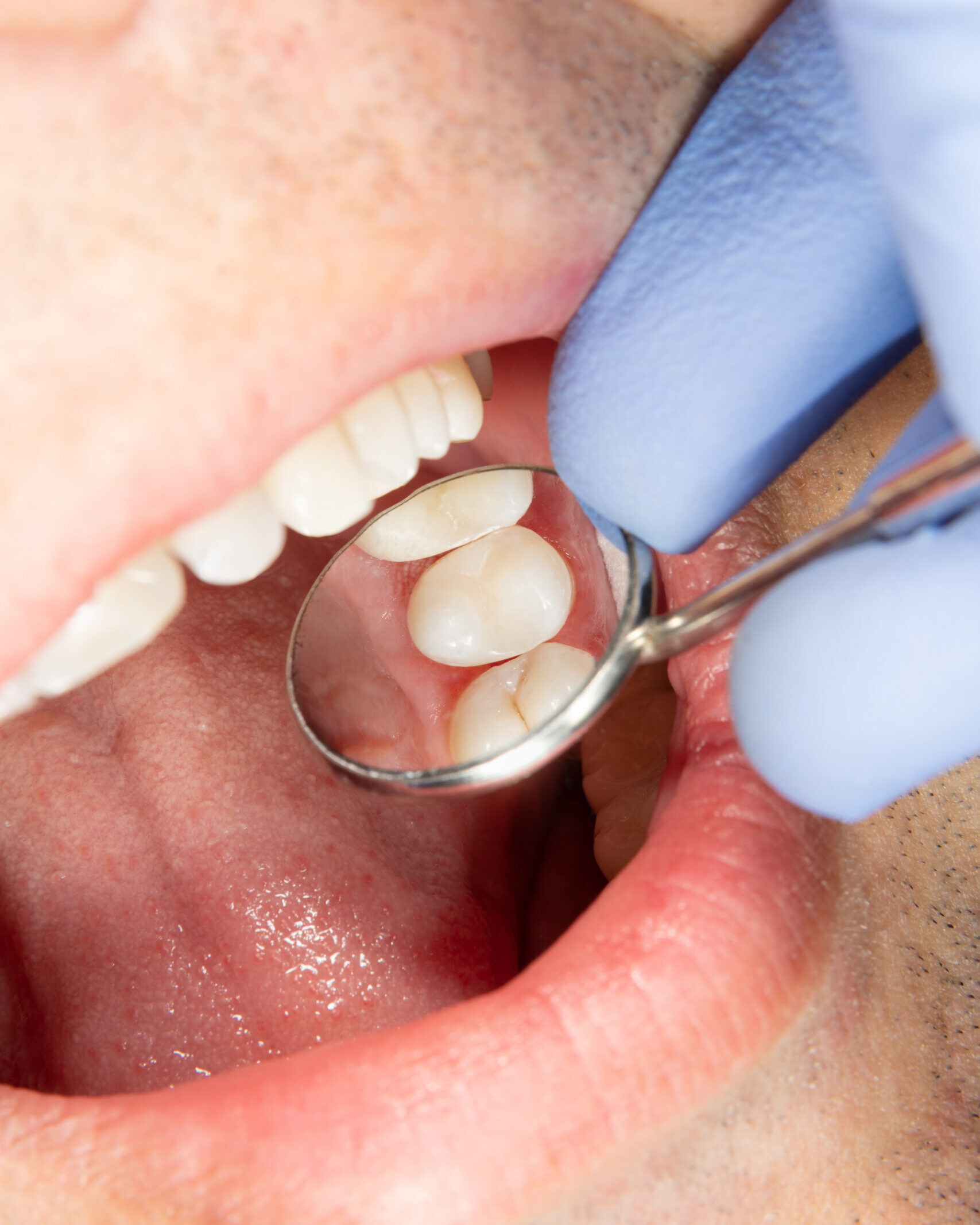 Caring for Your Sealed Teeth