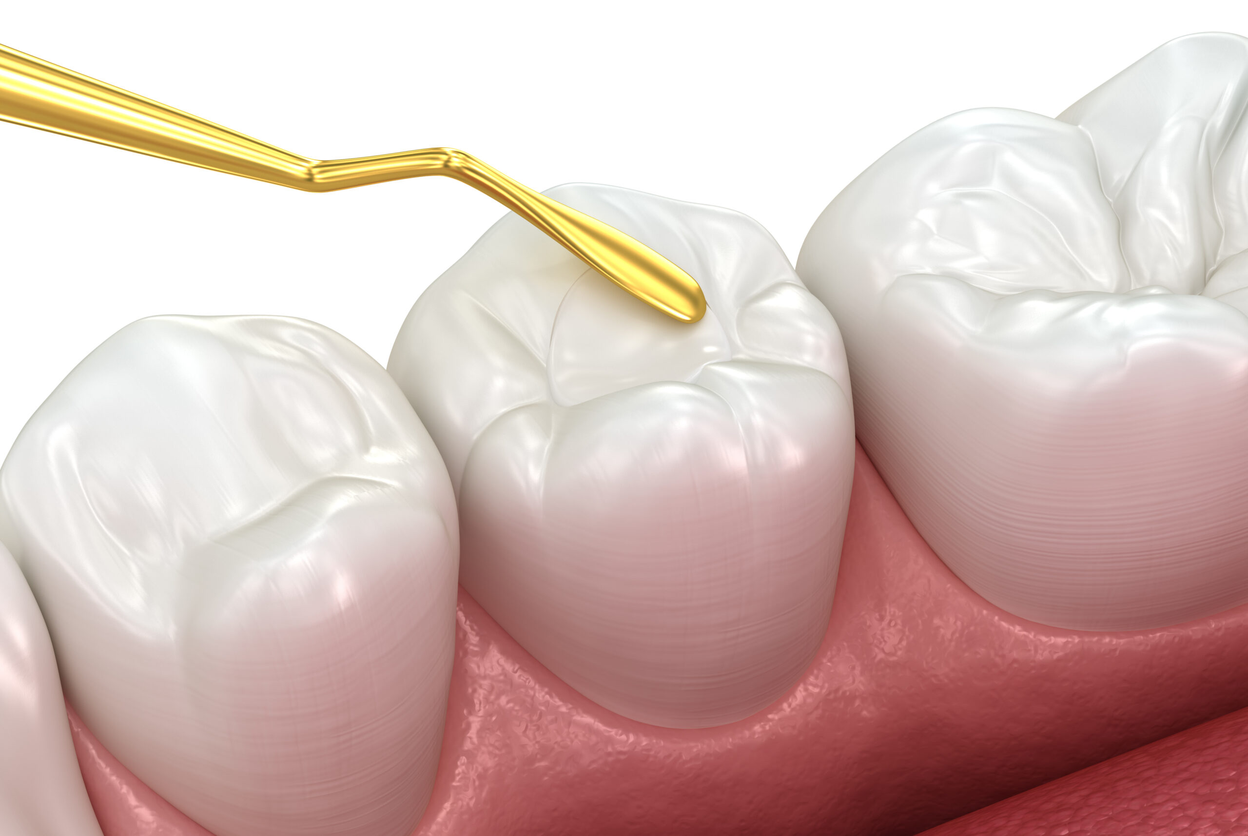 What Are Dental Sealants